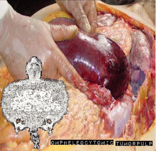 Urinary Tract Infection From Severe Pus Clots : Ompheleocytomic Tumorpulp Urinary Tract Infection From Severe Pus Clots : Ompheleocytomic Tumorpulp